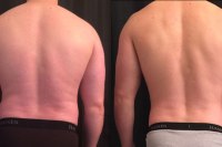 Before-After Cut Photo Results From Rear