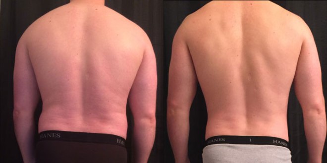 Before-After Cut Photo Results From Rear